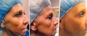 Before and after using Hydrafacials new ctgf solution